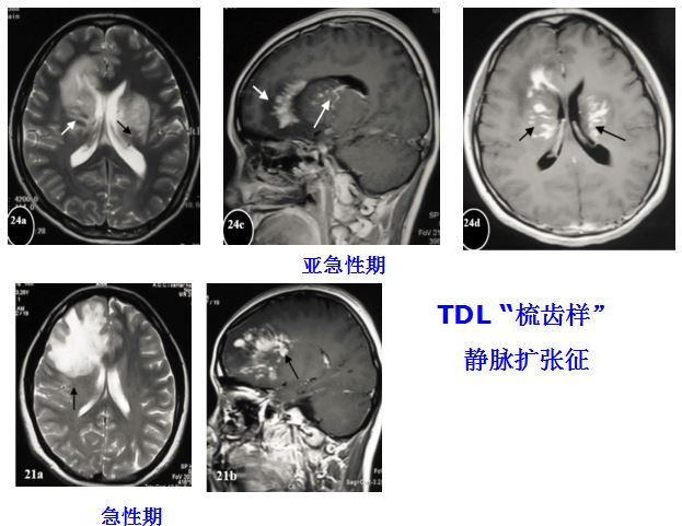 医学干货：瘤样炎性脱髓鞘病与胶质瘤、PCNSL临床、影像鉴别