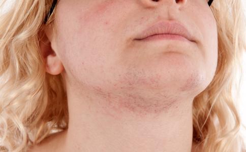 恼人的皮炎怎么治,春天季节性皮炎怎么办