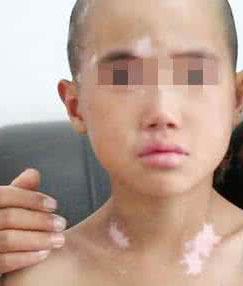 运动如何帮助白斑患者恢复？华夏提示注意事项？