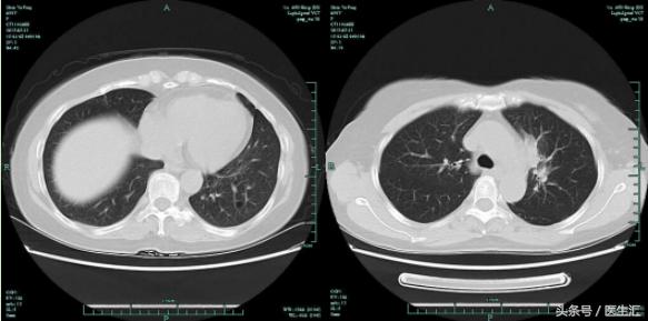 反复发烧咳嗽是否是肺结核,肺结核反复咳嗽怎么回事