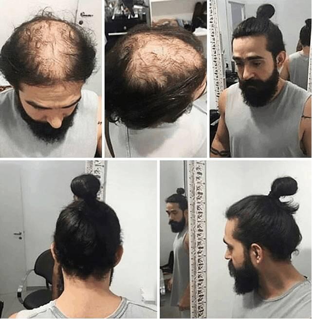 彻底摆脱脱发现在有什么技术,如何治愈脱发重新生发