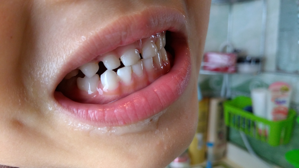 为何孩子蛀牙补完又补？选择合适的牙刷时刻注意口腔卫生