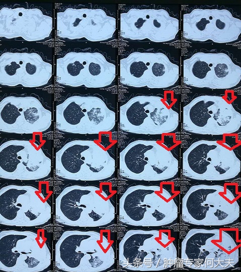 73岁老人得肺癌不治疗能活多久,77岁老人癌症晚期忽然喘不过气