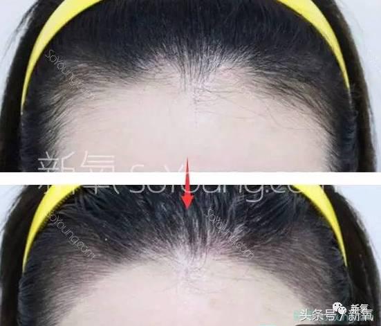 杨幂发际线还会回归吗,杨幂发际线秃到后脑勺