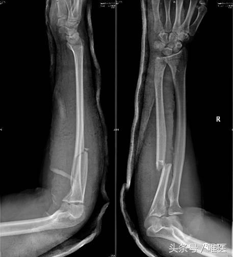 肱骨髓内钉的手术体位,肱骨髓内钉术后康复恢复步骤