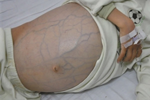 猫咪肝腹水有救吗,肝腹水有救吗