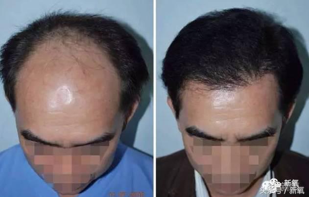 杨幂发际线还会回归吗,杨幂发际线秃到后脑勺