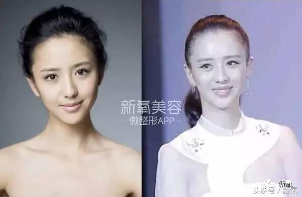 杨幂发际线还会回归吗,杨幂发际线秃到后脑勺