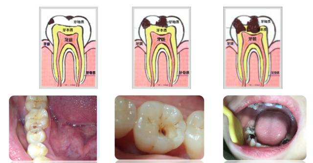 龋齿属于虫牙吗,蛀牙龋齿虫牙是怎么形成的