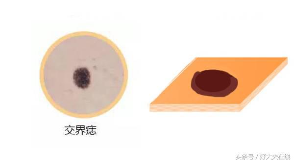 痣破损多久会有癌变的可能,浅表脂肪瘤样痣会癌变吗