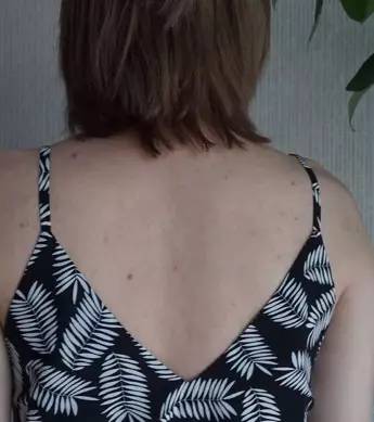 背上痘痘夏天怎么穿吊带,背后长痘痘怎么穿小吊带