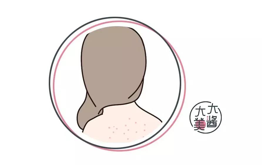 背上痘痘夏天怎么穿吊带,背后长痘痘怎么穿小吊带