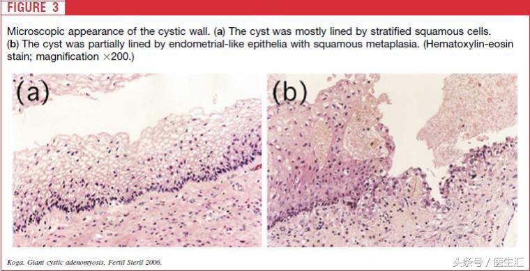 年轻子宫腺肌症患者综合治疗的病例分析