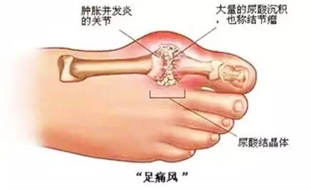 痛风会遗传下一代不会走路吗,痛风病能遗传下一代吗