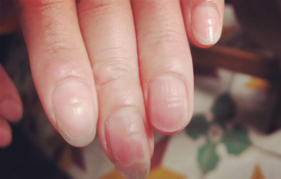 指甲里的黑线是什么物质,指甲若出现白点可能提示哪种情况