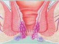 90岁的老人直肠脱垂严重怎么办,老年人直肠脱垂保守治疗