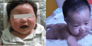 宝宝湿疹反反复复如何彻底根除,宝宝湿疹反反复复怎么根除