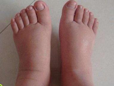 孕妈尿频解释,孕妈尿频