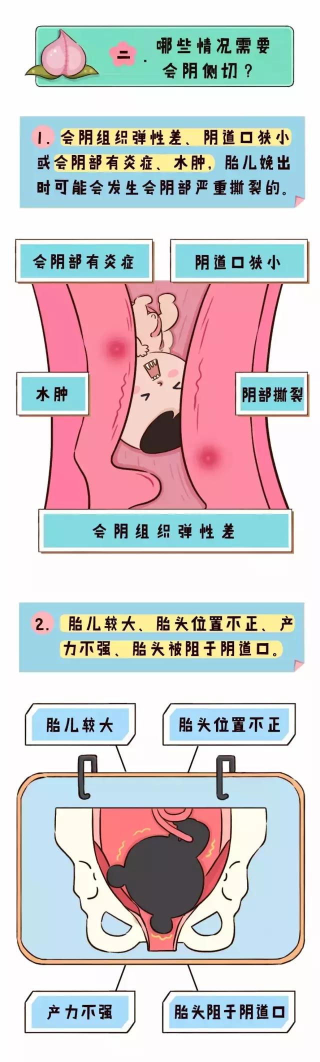 要不要做侧切,侧切过下一次也要侧切吗