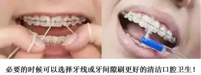 正畸戴牙环疼怎么办,正畸牙套戴不上了怎么办