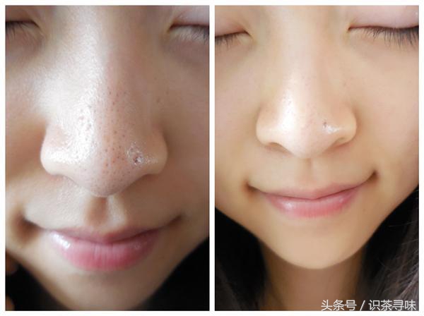 如何在家就能快速有效的去黑头,用这些方法去黑头很简单有效