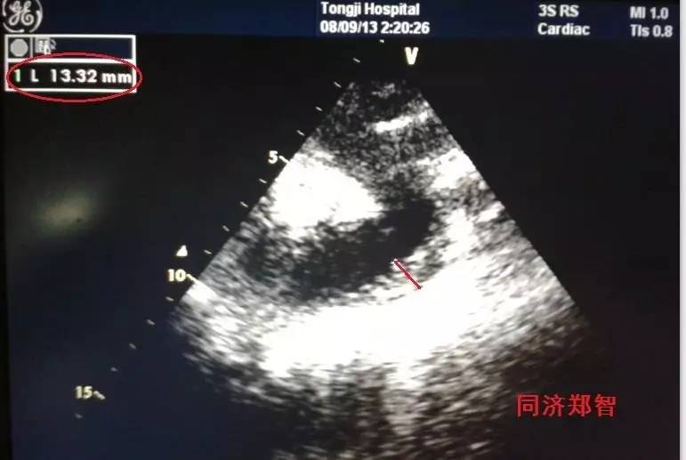 主动脉夹层差点要了老公的命,主动脉夹层兄妹