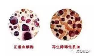 全身酸痛乏力流鼻涕高烧,大人身体消瘦流鼻血怎么回事