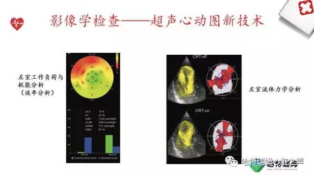 「心声」从机制到临床，一起认识左束支阻滞！