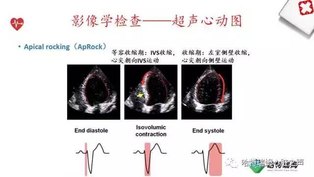 「心声」从机制到临床，一起认识左束支阻滞！