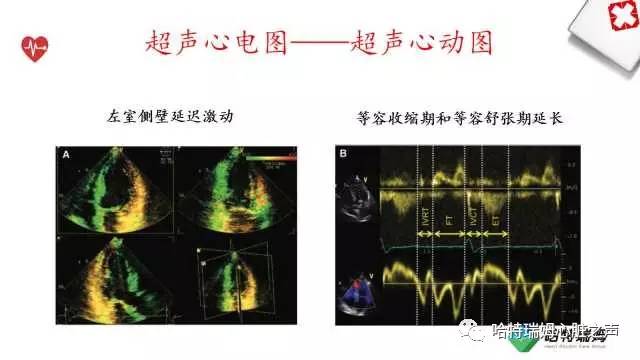 「心声」从机制到临床，一起认识左束支阻滞！
