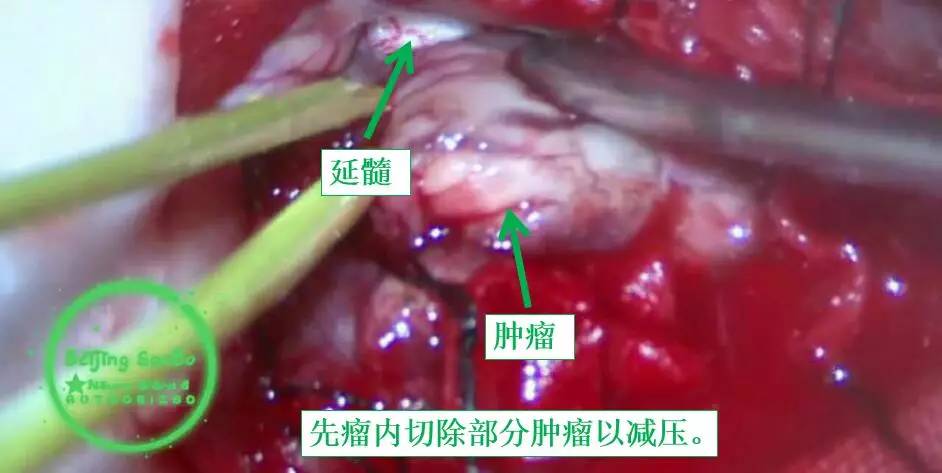 喝水容易呛是怎么回事是肺癌,老人喝水容易呛咳怎么办
