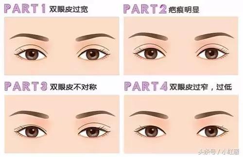 你的眼睛适合做什么手术,你的双眼皮什么时候做