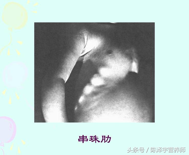 孩子25羟基维生素d严重缺乏表现,25羟基维生素d严重缺乏吃什么药