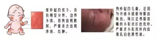 宝宝痱子不管它自己能好吗,宝宝痱子误区