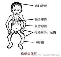 孩子25羟基维生素d严重缺乏表现,25羟基维生素d严重缺乏吃什么药