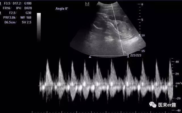 孕期胎儿左心室强回声斑怎么回事,右心室点状强回声对胎儿有影响吗