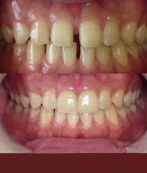 口腔医生怎么消除拔牙恐惧,对拔牙有恐惧怎么缓解