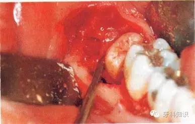 口腔拔牙图片,口腔拔牙麻醉多久消退