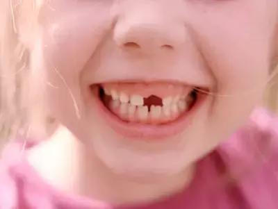 牙齿轻微缺损需要处理吗,牙齿楔状缺损修补多少钱