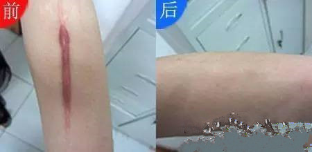 宝宝摔倒的伤疤怎样不留疤痕,宝宝摔倒怎么不留疤