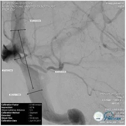 脑静脉窦狭窄做支架危险吗,静脉窦狭窄做支架后多久恢复