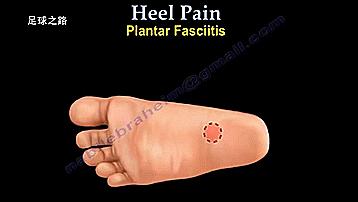 足跟痛最常见病因,足跟痛警惕四种疾病