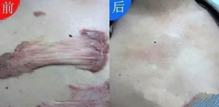 宝宝摔倒的伤疤怎样不留疤痕,宝宝摔倒怎么不留疤