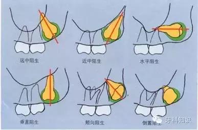 口腔拔牙图片,口腔拔牙麻醉多久消退