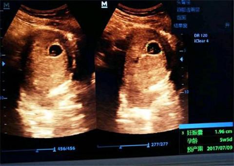 怀孕两个月没胎心会有孕吐反应吗,孕妇怀孕两个月了没有任何感觉