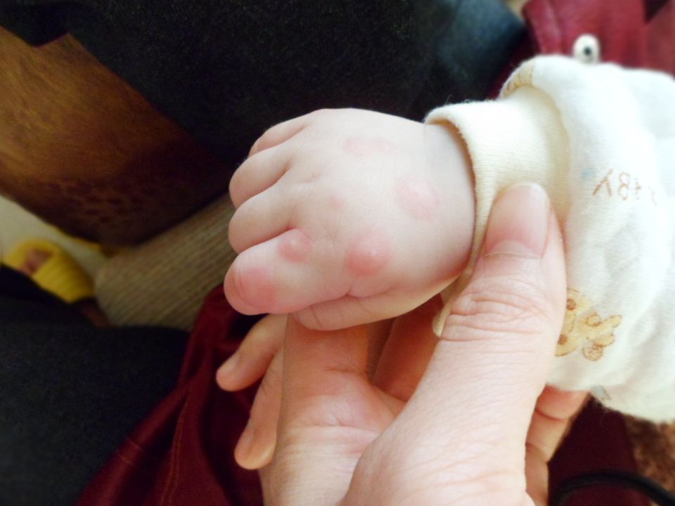 幼儿手足口病给家长温馨提示,孩子手足口病要怎么跟家长沟通