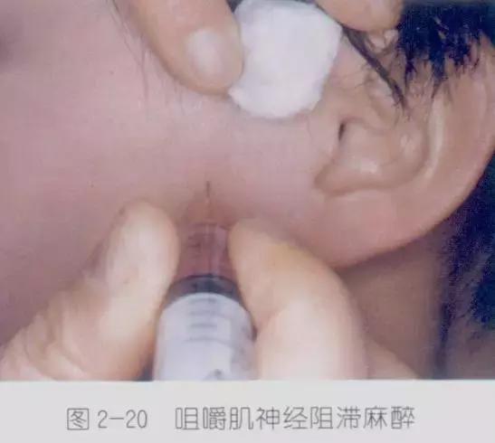 口腔麻醉方法,睡眠麻醉口腔