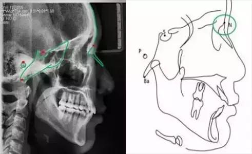 正畸最常用的头影测量法,口腔正畸学入门必学之头影测量