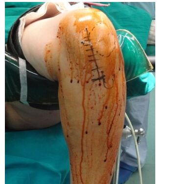 膝盖半月板损伤的锻炼方法,治疗膝盖半月板损伤的方子