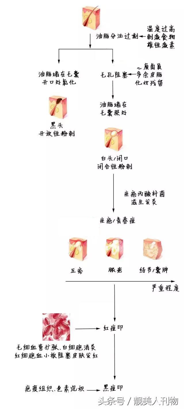 还在长痘痘还有痘坑怎么办,正在长痘怎么祛痘